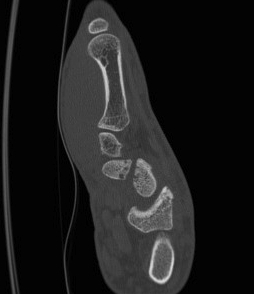 Scaphoid Nonunion Humpback Deformity CT
